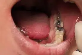 veneers, carillas, cheapest, miami, kendall, downtown, southbeach, fiu, closest to me, Dentist near me, dentista cerca de mi, best dentist miami, mejor dentista miami, pizza near me, chinese near me, food near me, crown dentist miami, cheapest dentist miami, root canal dentist miami, cheapest root canal miami