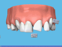 Ceramic braces procedure at Dr. G Dental Studio Miami